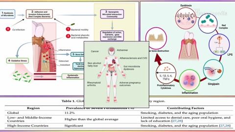 The Global Burden of Periodontal Disease