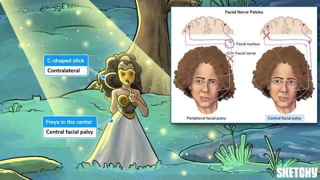 Cranial Nerve VII (Facial): Clinical Correlates - Free Sketchy Medical ...