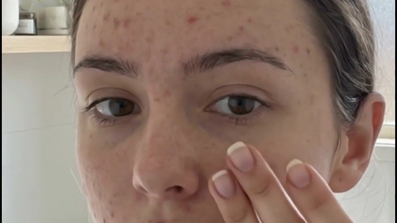 Acne Solution with Exposed Skincare